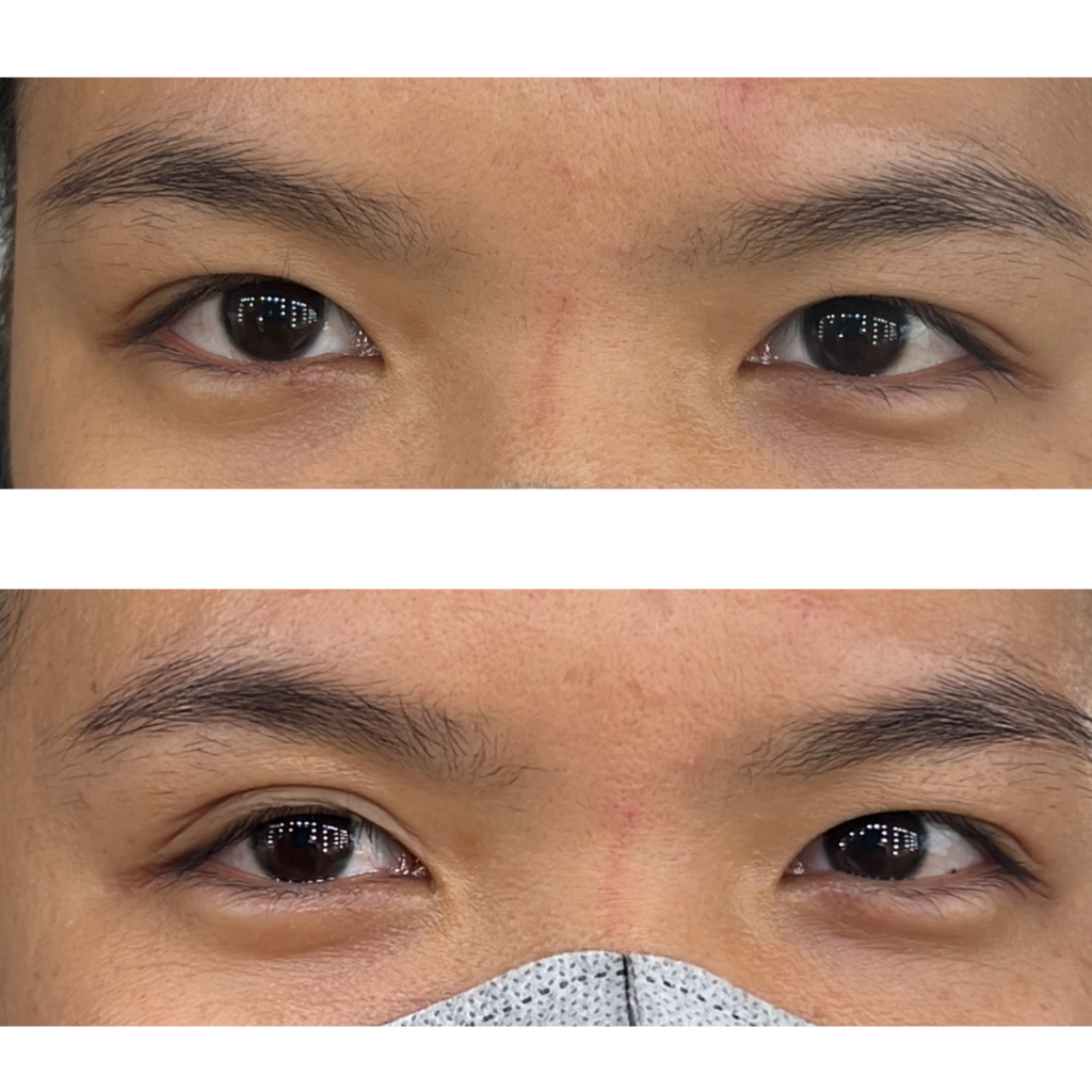 Invisible Eyelid tape