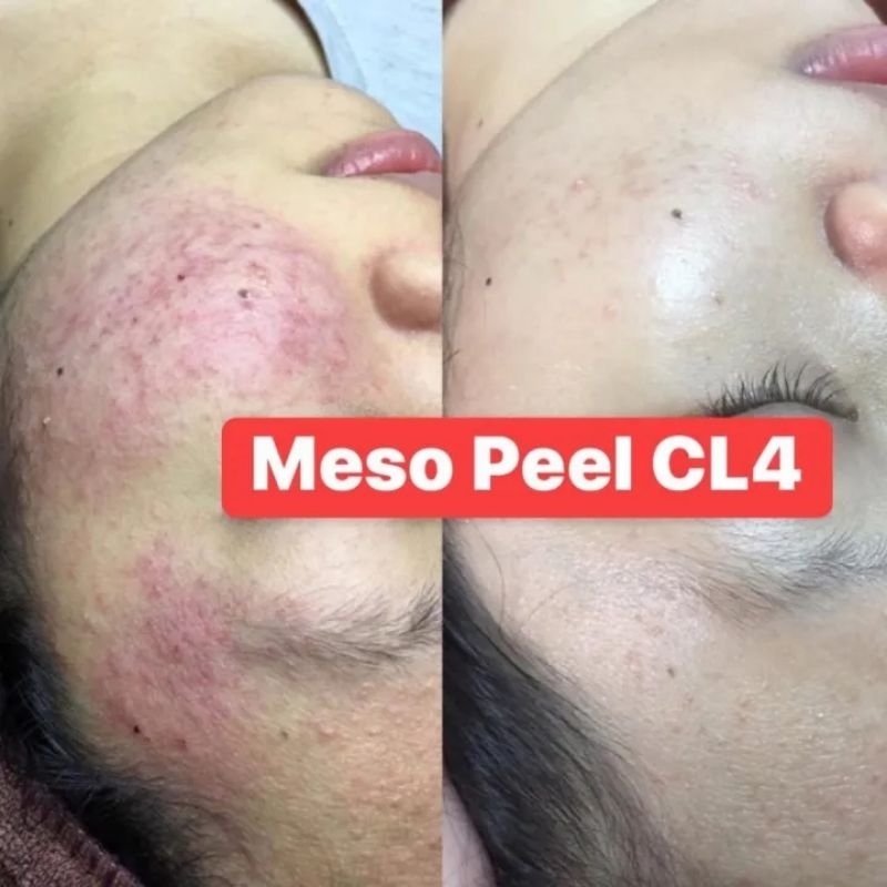 Meso Peel CL4 ISOV - Peel Thảo Dược