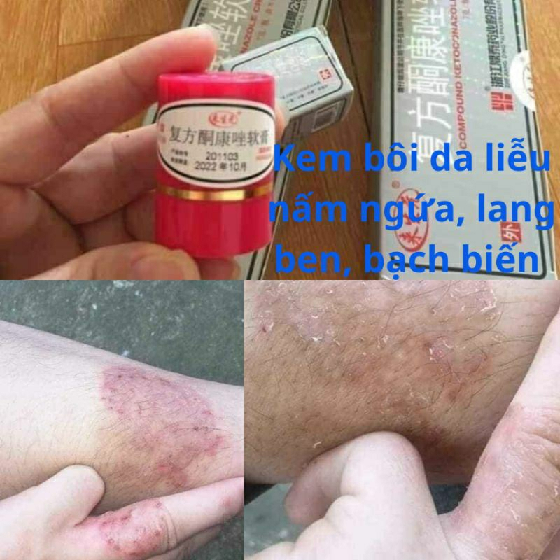 Kem bôi hắc lào, nấm ngứa, á sừng, lang ben, vẩy nến - Hàng sẵn.