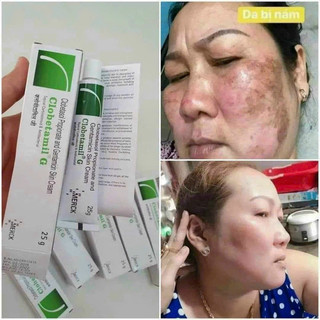 Tuýp nám Clobetamil G ngừa nám tàn nhang 25g