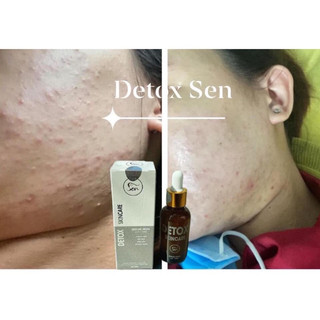 Serum mụn Sen