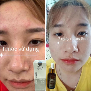 Serum mụn Sen