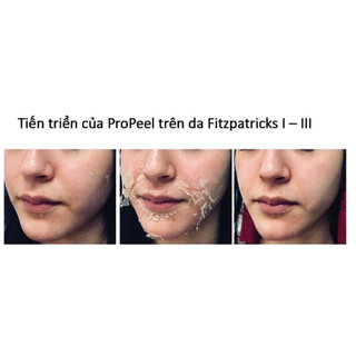𝐕𝐢𝐯𝐚𝐧𝐭 𝐏𝐫𝐨 𝐏𝐞𝐞𝐥 ( dùng thử 1 lần)