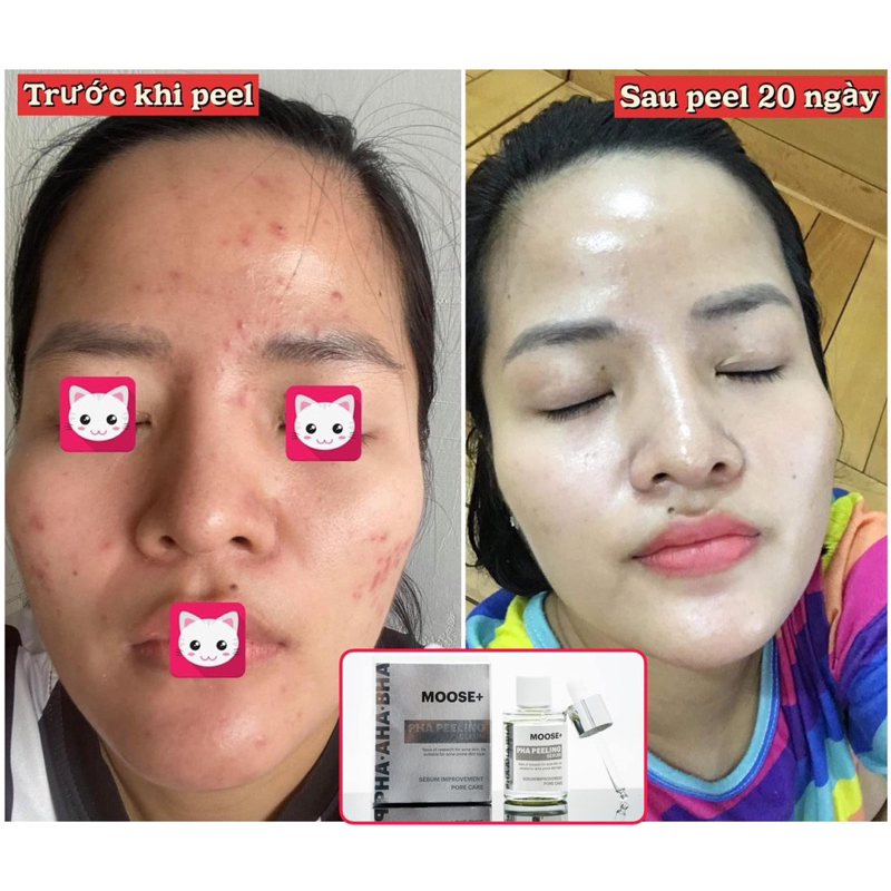 PHA PEELING SERUM MOOSE+ HÀN QUỐC