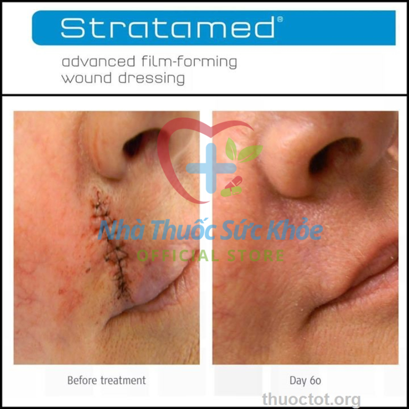 Stratamed Kem sẹo hỗ trợ làm lành vết thương hở và giúp mờ sẹo thâm, sẹo lõm, sẹo lồi,Stratamed chính hãng  5g/10g