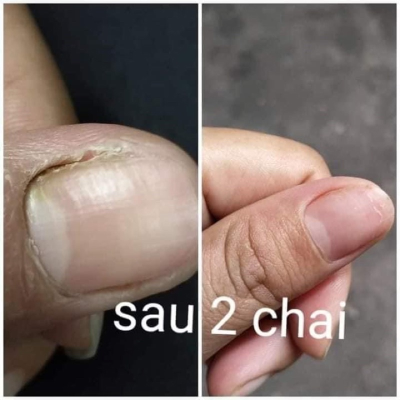 Combo 10 Serum Nấm Móng Tay Chân Serum Khử Nấm Móng Cải Thiện Hư Khóe Bọng Móng Nước Ăn Tay Chân