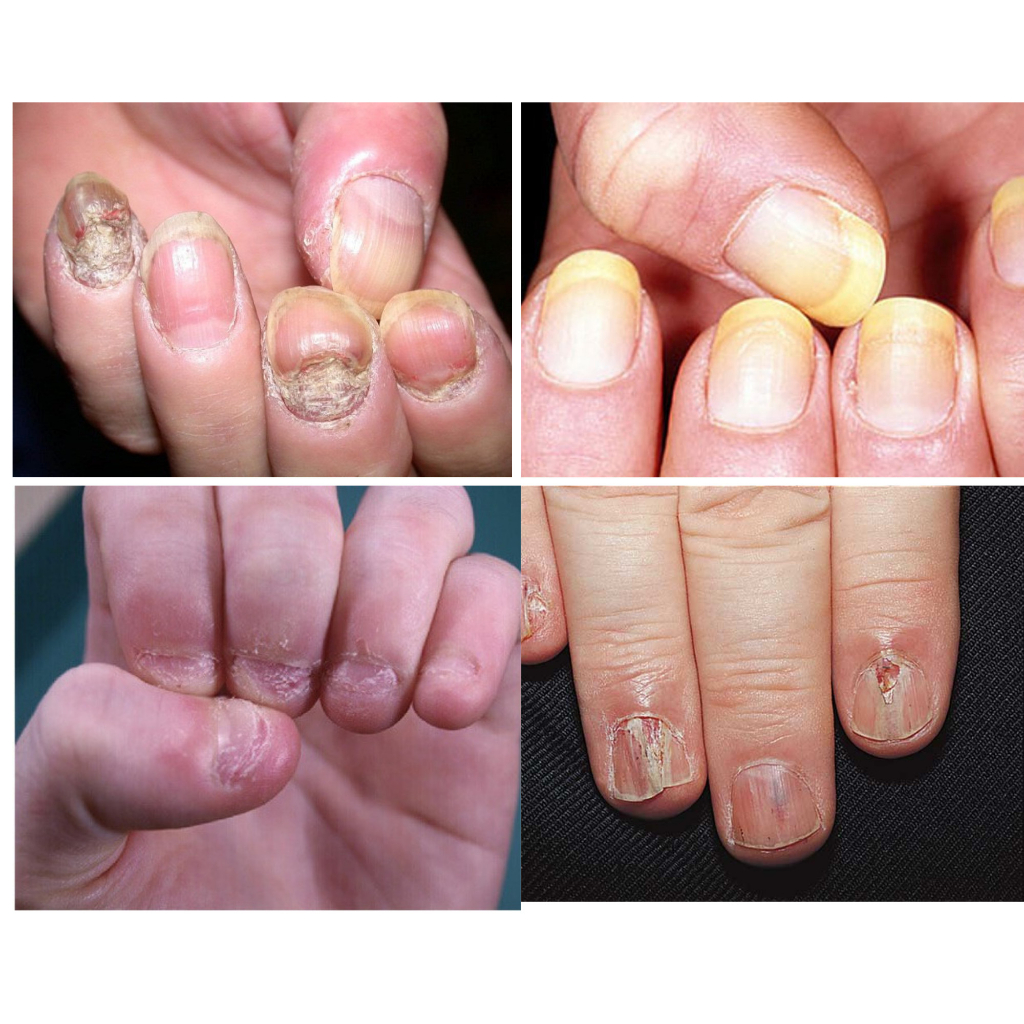 Combo 10 Serum Nấm Móng Tay Chân Serum Khử Nấm Móng Cải Thiện Hư Khóe Bọng Móng Nước Ăn Tay Chân