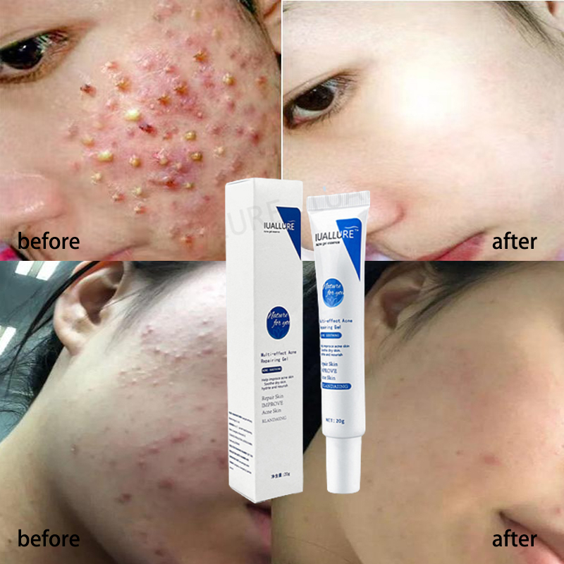 Kem mụn Gel mụn lột mụn Mụn trứng cá 20g Loại bỏ mụn trứng cá loại bỏ mụn làm mờ mụn Kháng khuẩn chống viêm