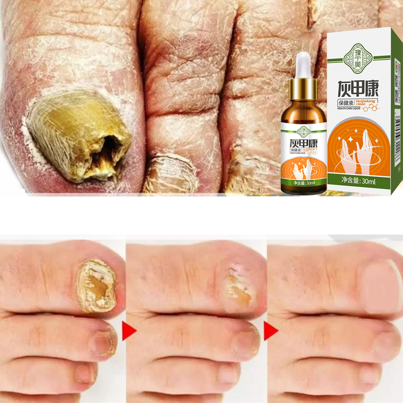 Kem nấm móng phục hồi móng gel Loại bỏ nấm móng tay vết nứt móng tay ngứa phù móng chân Dưỡng da tay và chân 15g