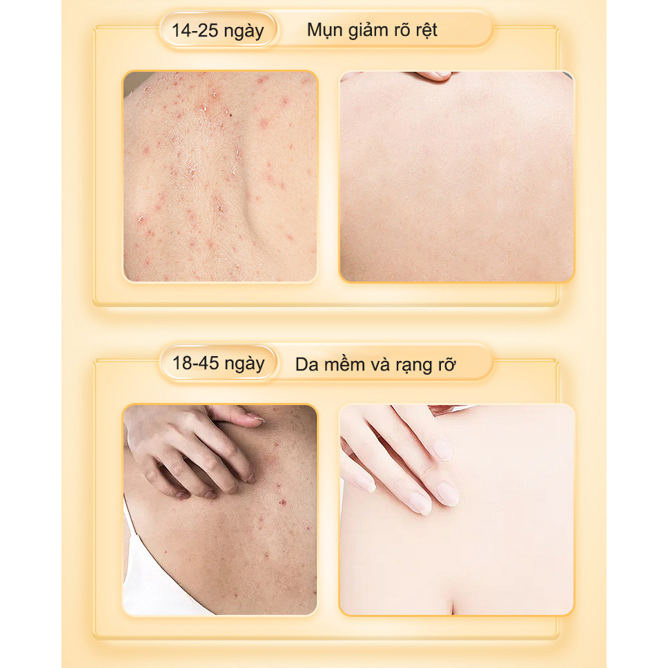 Sữa  tắm trắng da sữa tắm mụn lưng sữa tắm viêm nang lông 400ML chiết xuất 100% suối lưu huỳnh tự nhiên.