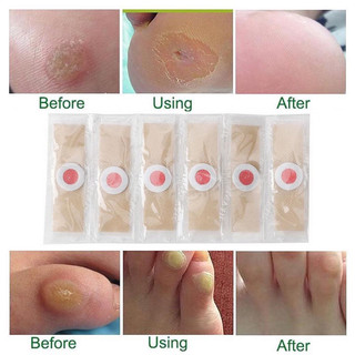 [6 Miếng] Miếng Dán Mụn Cóc, Mụn Cơm, Dán Vết Chai Chân