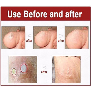 [6 Miếng] Miếng Dán Mụn Cóc, Mụn Cơm, Dán Vết Chai Chân