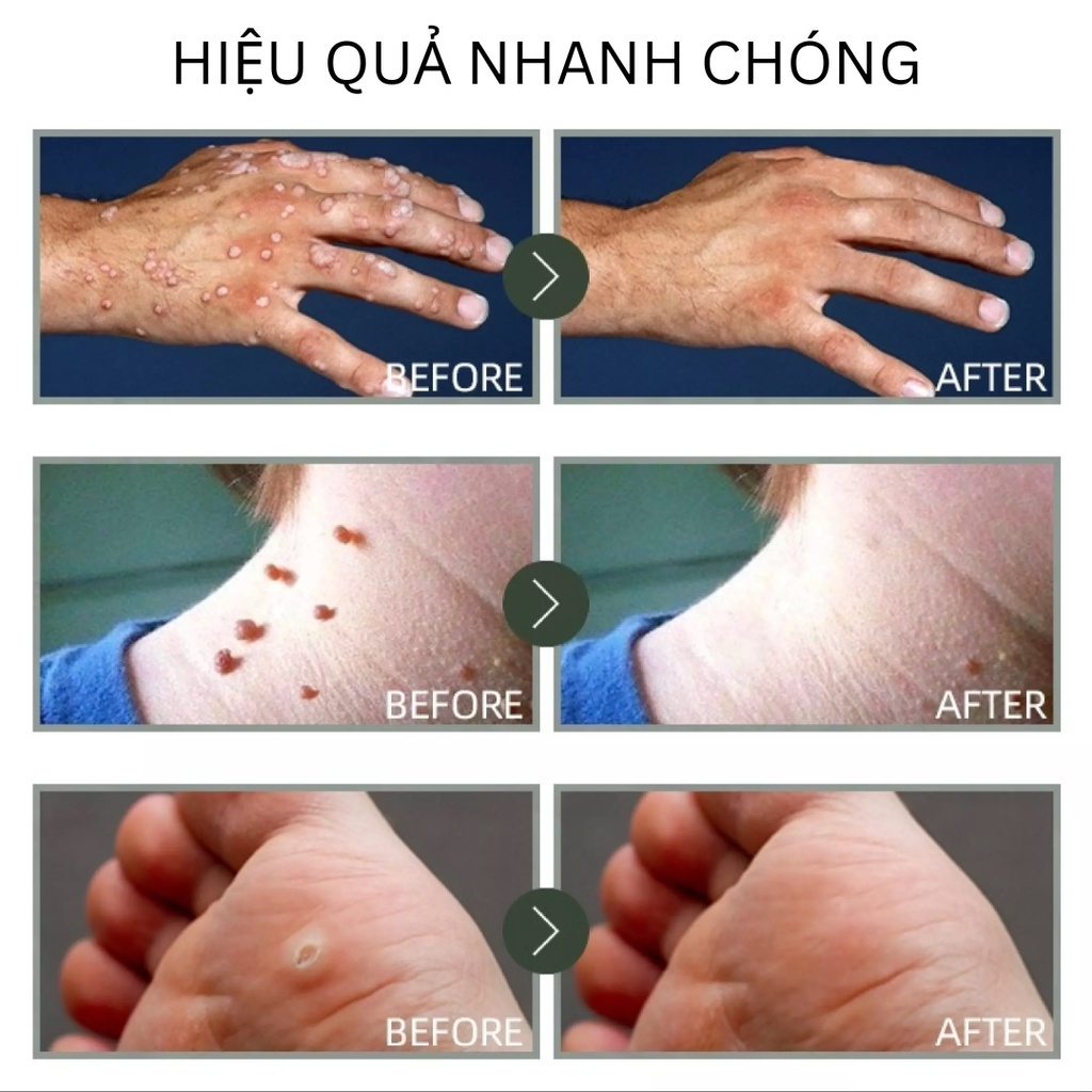 Thuốc trị mụn cóc kem xóa mụn cóc 10ml dịu nhẹ xóa sạch mụn mắt cá mụn thịt mụn cóc gan bàn chân mụn cơm