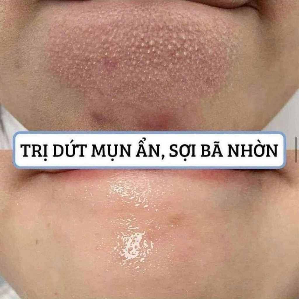 Serum Tinh chất Ngừa mụn SEOHAL