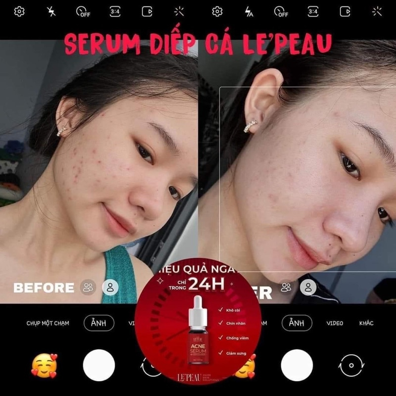 Serum Giảm Mụn Thâm Sẹo Rỗ ACNE Chấm mụn diếp cá - LE'PEAU