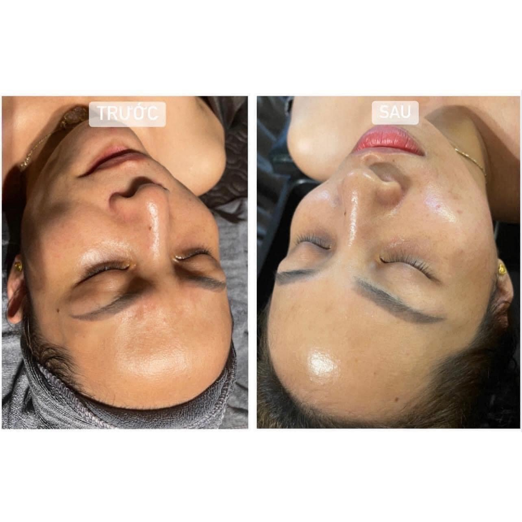 INNOAESTHETICS, Tinh chất peel MCA 35  da giảm nếp nhăn trẻ hóa da - 5ml/ lọ