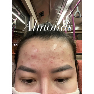 Cao mụn  Acnes Skin Care Almonds
