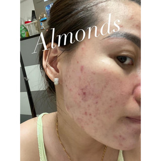 Cao mụn  Acnes Skin Care Almonds