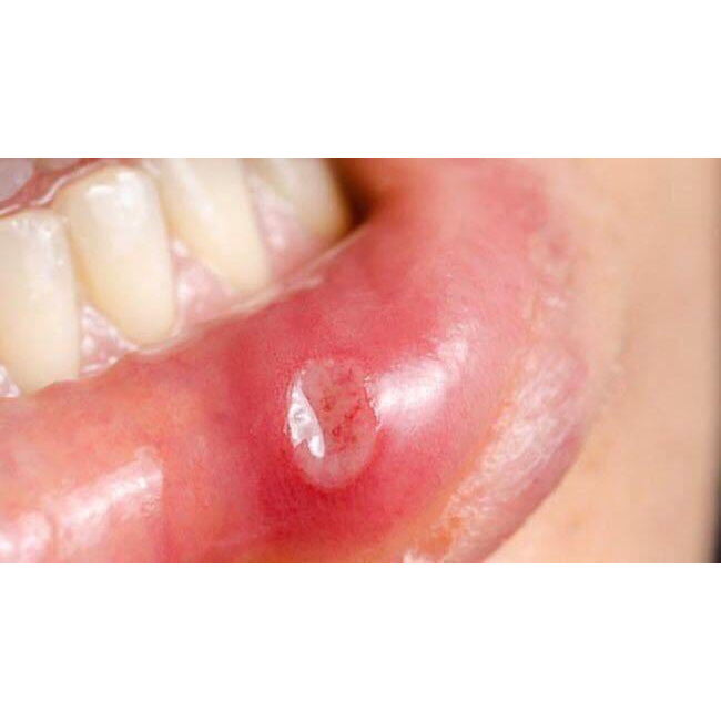 Kem bôi giảm nhiệt miệng , viêm lưỡi Sato  - Nhật