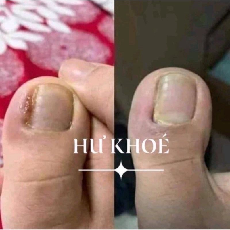 Serum đánh bay nấm móng, hư khoé, bọng móng, nước ăn tay chân gia truyền 4ml