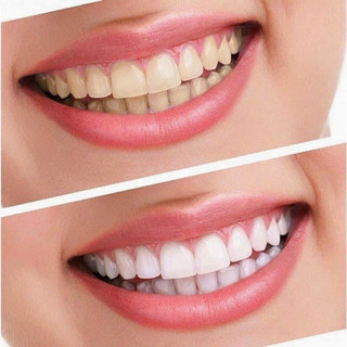 𝐊𝐄𝐌 Đ𝐀́𝐍𝐇 𝐑𝐀̆𝐍𝐆 𝐒𝐈𝐄̂𝐔 Trắng 𝐂𝐑𝐄𝐒𝐓 𝟑𝐃 𝐖𝐇𝐈𝐓𝐄 của Mỹ (1 typ )