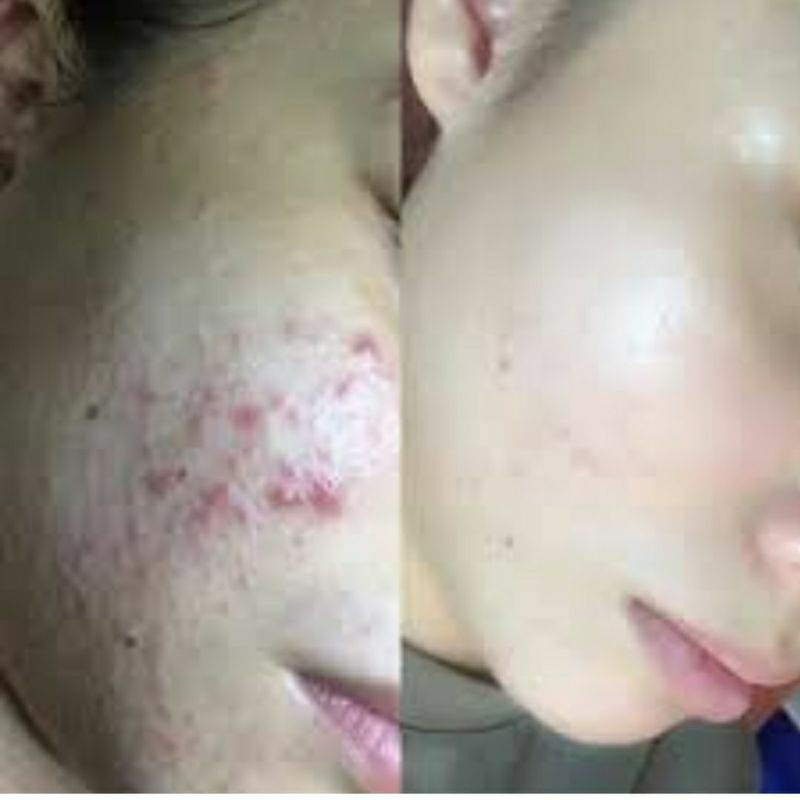 10ML Cao lá nam chuyên mụn,thâm cao cấp mix saffaron