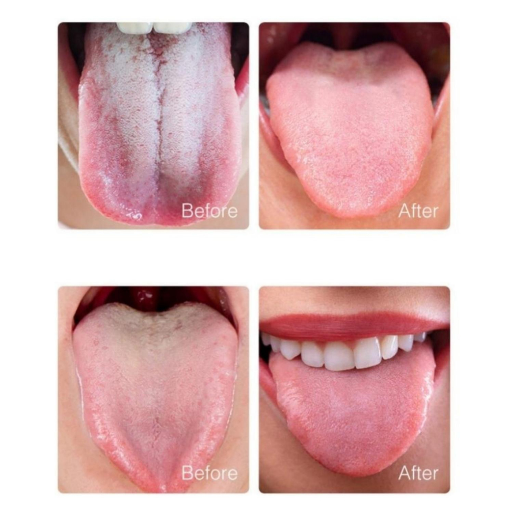 Kem Đánh Răng Hàn Quốc Median Dental, Kem Đánh Răng Trắng Răng Loại Sạch Mảng Bám Ngăn Ngừa Nhiệt Miệng Ngừa Sâu Răng