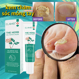 Thuốc trị nấm móng Kem Bôi Nấm Móng Tay Chân 20g Giúp loại bỏ nấm khỏi móng chân bị thối Cải thiện vết nứt móng