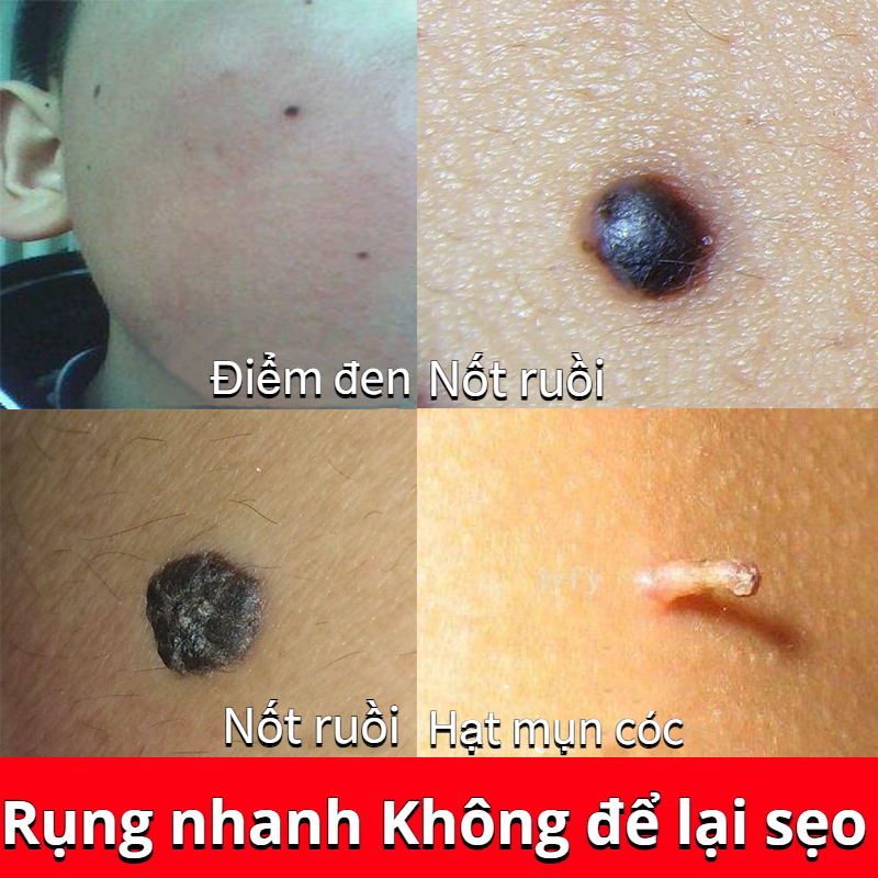Dung dịch phục hồi xóa nốt ruồi10ml,Mụn ruồi đen/Mụn ruồi lồi/Mụn ruồi thịt Serum Loại Bỏ Nốt Ruồi Và Tàn Nhang Hiệu Quả