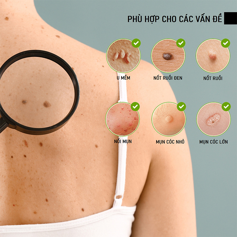 Dung dịch phục hồi xóa nốt ruồi10ml,Mụn ruồi đen/Mụn ruồi lồi/Mụn ruồi thịt Serum Loại Bỏ Nốt Ruồi Và Tàn Nhang Hiệu Quả