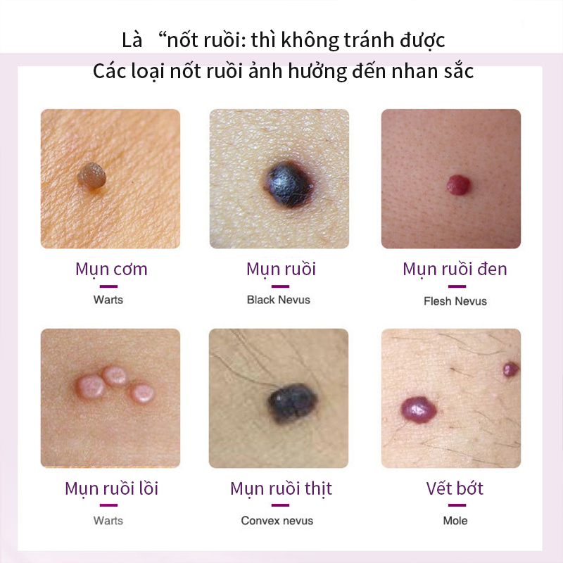 Dung dịch phục hồi xóa nốt ruồi10ml,Mụn ruồi đen/Mụn ruồi lồi/Mụn ruồi thịt Serum Loại Bỏ Nốt Ruồi Và Tàn Nhang Hiệu Quả