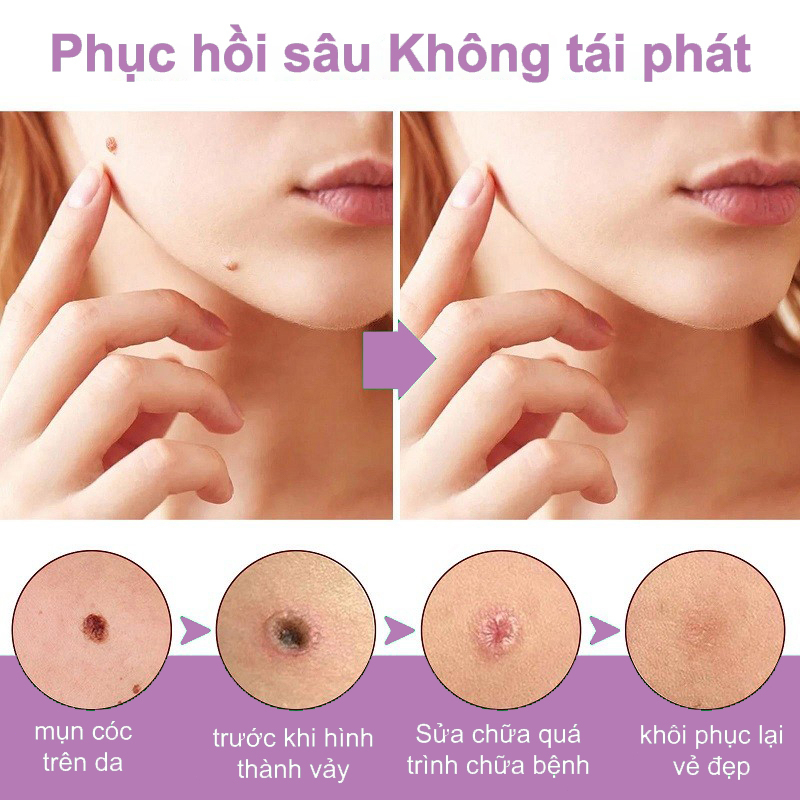 Dung dịch phục hồi xóa nốt ruồi10ml,Mụn ruồi đen/Mụn ruồi lồi/Mụn ruồi thịt Serum Loại Bỏ Nốt Ruồi Và Tàn Nhang Hiệu Quả