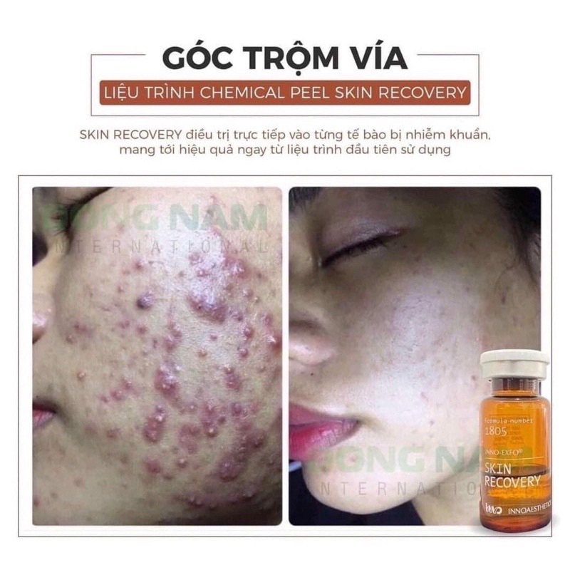 Tinh Chất Peel Cho Da Sẹo Rỗ T.C.AGE Innoaesthetics