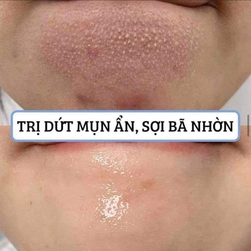 Tinh chất The Ordinary BHA AHA Peeling Solution 30ml