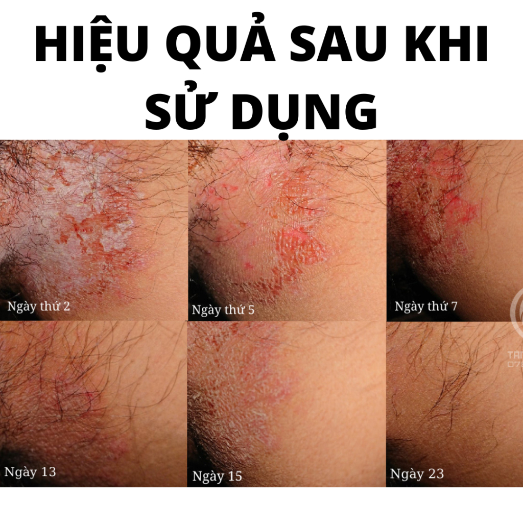 Xịt balanitis hỗ trợ loại bỏ sùi mào gà, gai sinh duc, hạt ngọc vùng kín sau 1 tuần sử dụng