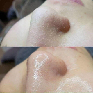 Ủ mụn đầu đen removes blackhead