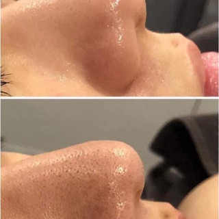 Ủ mụn đầu đen removes blackhead