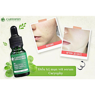 Serum Caryophy ngăn ngừa mụn và thâm Chính Hãng