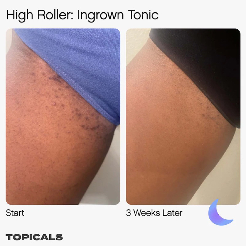 Tinh chất lăn ngăn ngừa lông mọc ngược Topicals High Roller Ingrown Hair Tonic with AHA and BHA