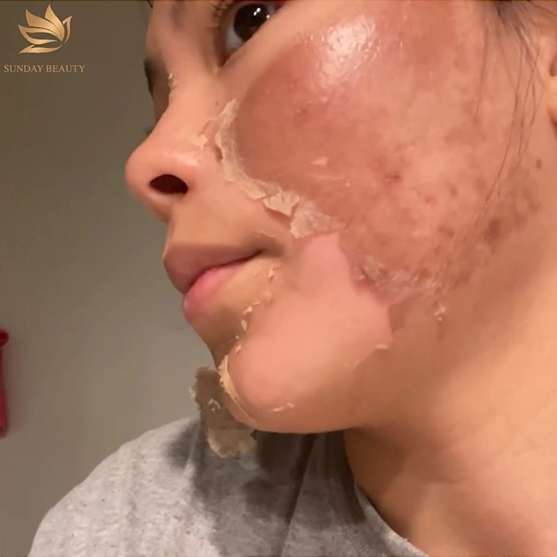 Tinh chất peel da ROYCE SKIN M+ bóc tách nám tàn nhang sẹo rỗ lõm mụn thâm