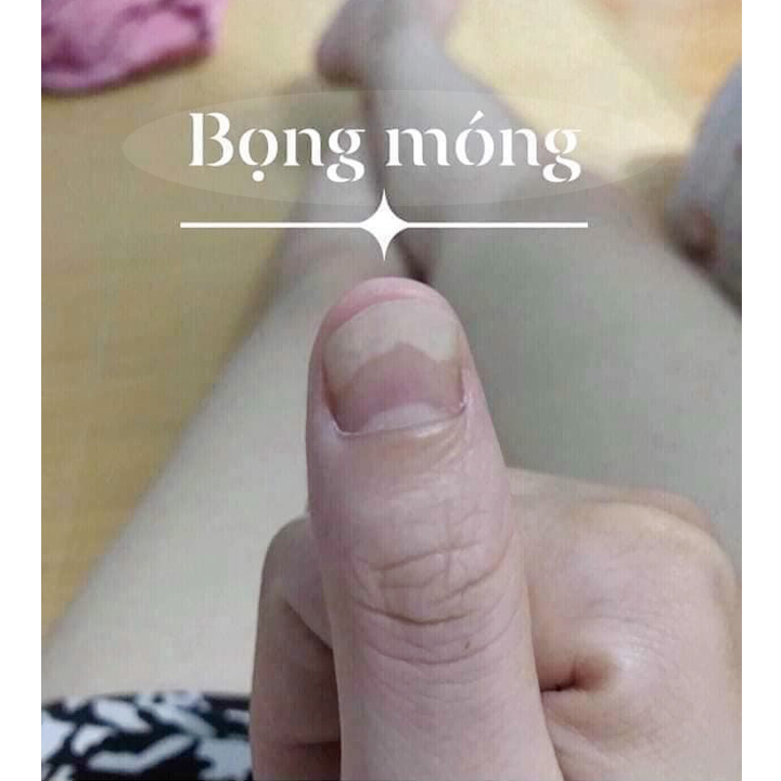 Serum Nấm Móng Tay Chân, Hết Sạch Nấm, Bọng Móng, Hư Khoé, Nước Ăn Tay Chân, Dưỡng Cứng Móng