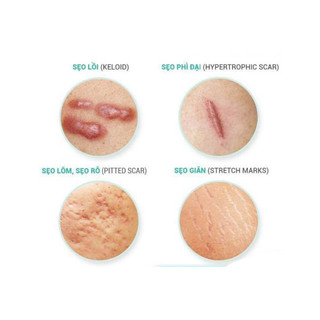 Kem mờ sẹo Klirvin Nga 25g