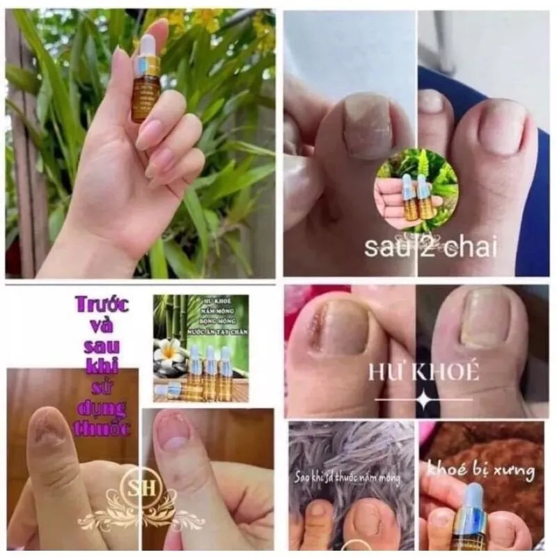 Serum đánh bay nấm móng, hư khoé, bọng móng, nước ăn tay chân gia truyền