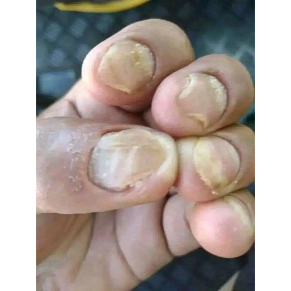 Serum đánh bay nấm móng, hư khoé, bọng móng, nước ăn tay chân gia truyền