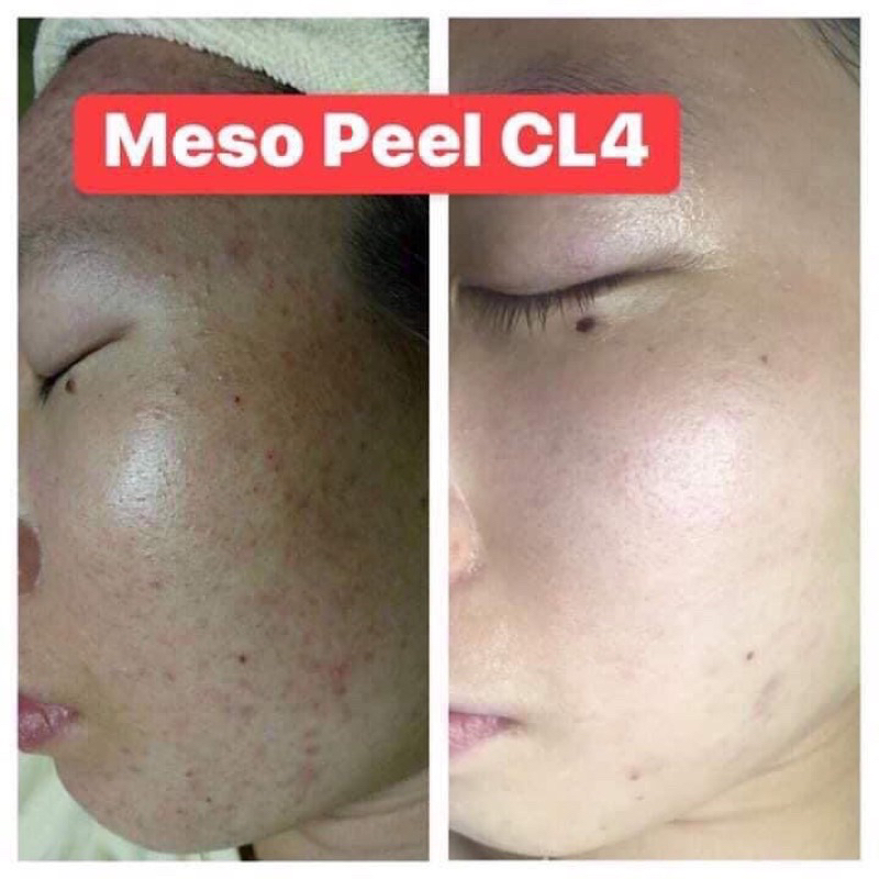 Meso Peel CL4 ISOV - Peel Thảo Dược