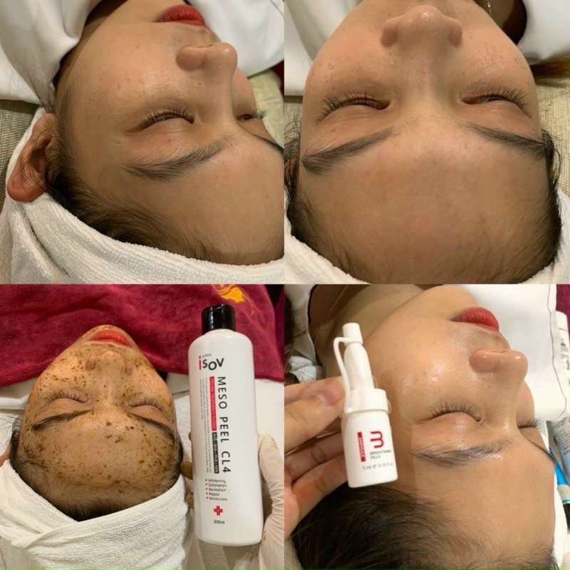 Combo Peel meso cl4 Mịn Da - Trắng Da - Căng bóng - Mờ Thâm