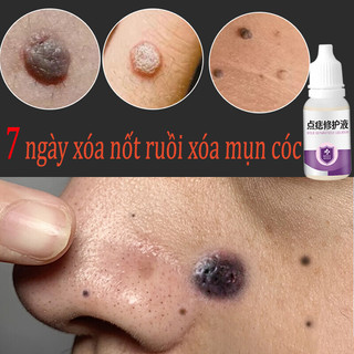 Thuốc tẩy nốt ruồi mụn cóc Kem tẩy mụn cóc 10ml 7 ngày nhanh chóng xóa bỏ mụn cóc mụn ruồi đen lồi