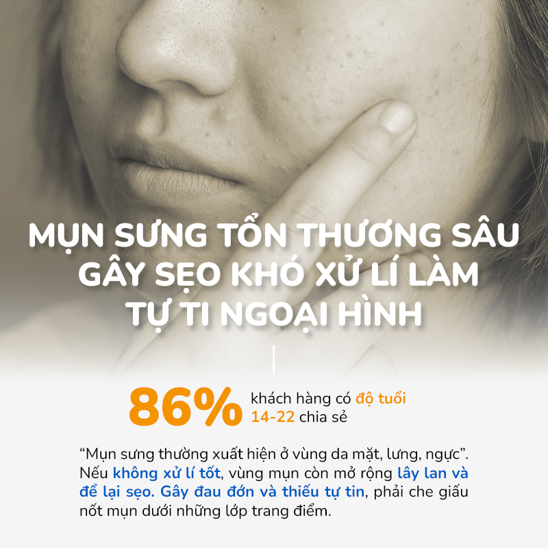 Serum Chấm Mụn Và Giảm Thâm Cấp Tốc 24H Tinh Dầu Tràm Trà Úc Anti Acnes NEOSKIN 20ml