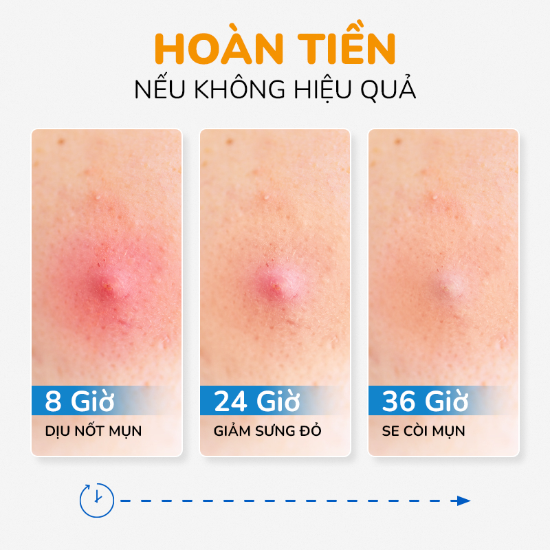 Serum Chấm Mụn Và Giảm Thâm Cấp Tốc 24H Tinh Dầu Tràm Trà Úc Anti Acnes NEOSKIN 20ml