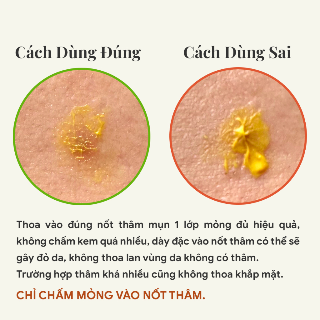 Kem chấm mờ thâm sau mụn Giggle 5gam